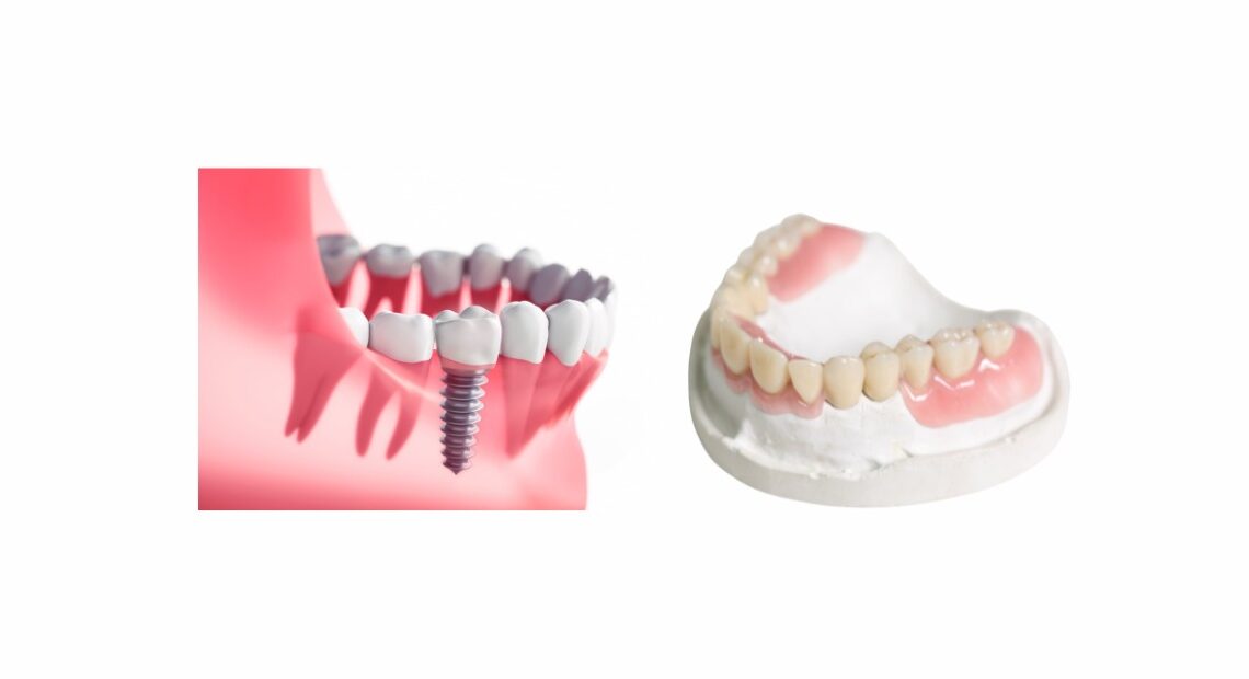 implate dentario e protese dentaria